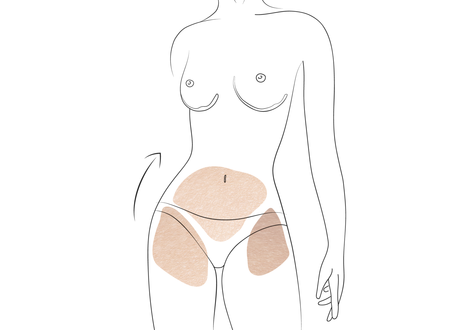 Bodylift ali lifting celotnega telesa