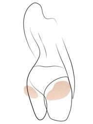 Klinika višnjar - brazilski dvig zadnjice