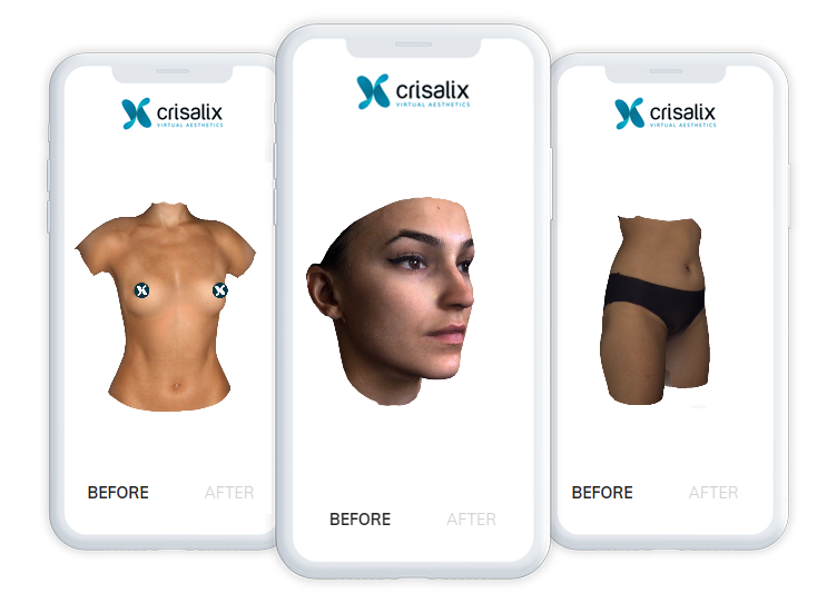Tri mobilne naprave prikazujejo 3D-skenirane dele telesa (prsni koš, obraz in trebuh) v aplikaciji Crisalix Virtual Aesthetics, z oznakami 'Before' (pred posegom) in logotipom Crisalix na vrhu zaslona.