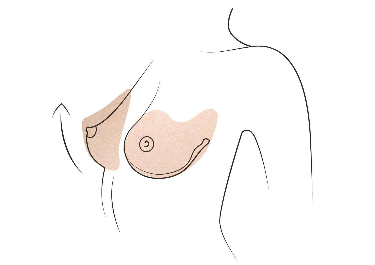 Klinika višnjar - dvig prsi