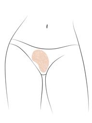 Klinika višnjar - Korekcija malih sramnih ustnic (labioplastika)