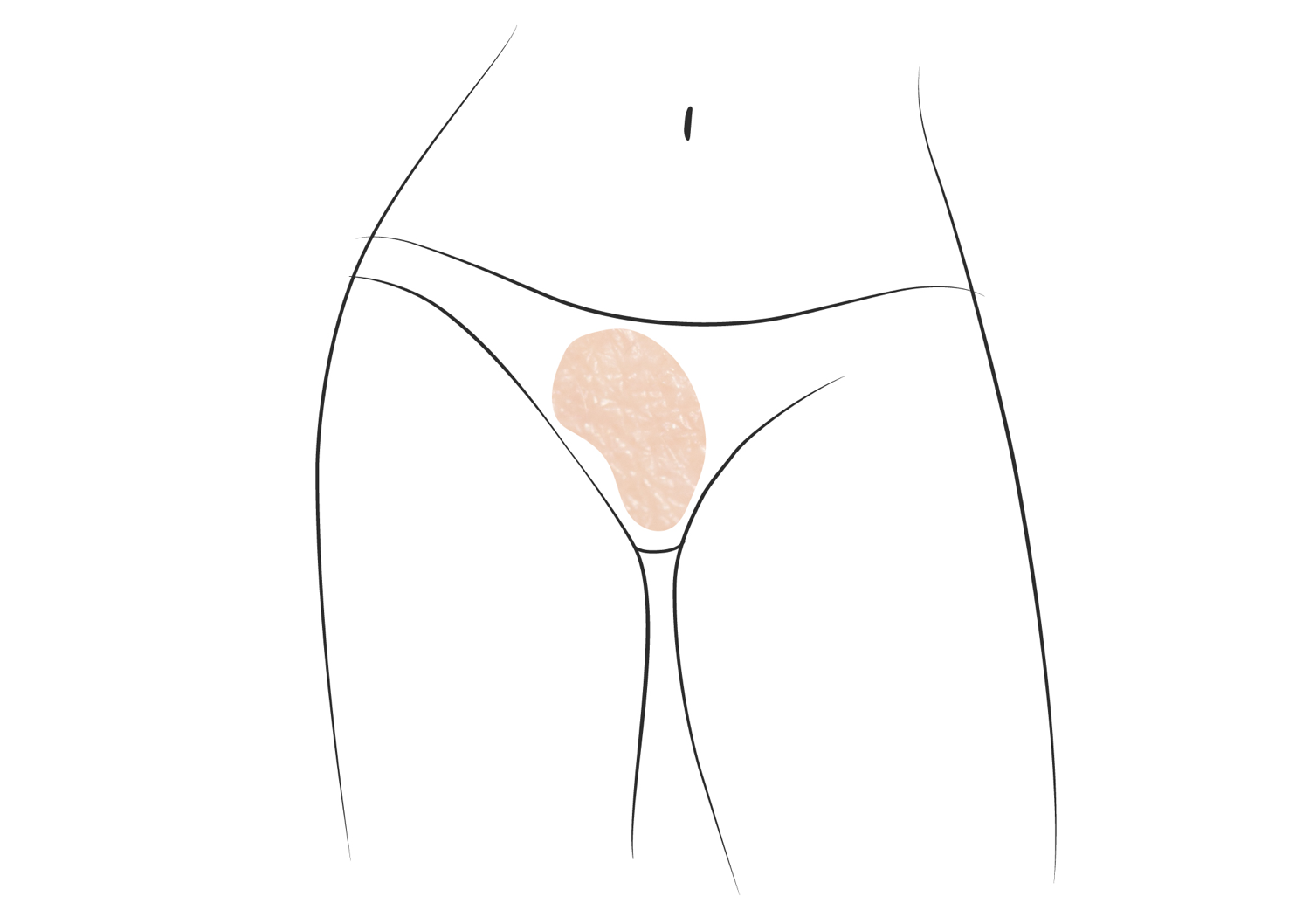 Klinika višnjar - Korekcija malih sramnih ustnic (labioplastika)