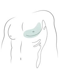 Klinika višnjar - Korekcija moških prsi (ginekomastija)