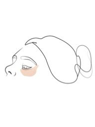 Klinika višnjar - korekcija spodnjih vek