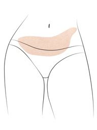 Klinika višnjar - korekcija trebuha