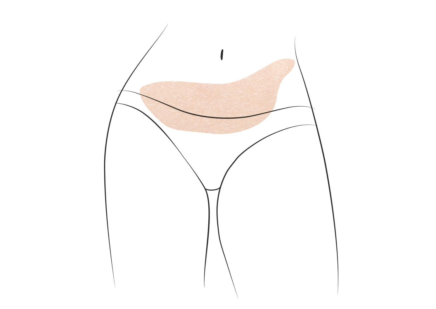 Klinika višnjar - korekcija trebuha