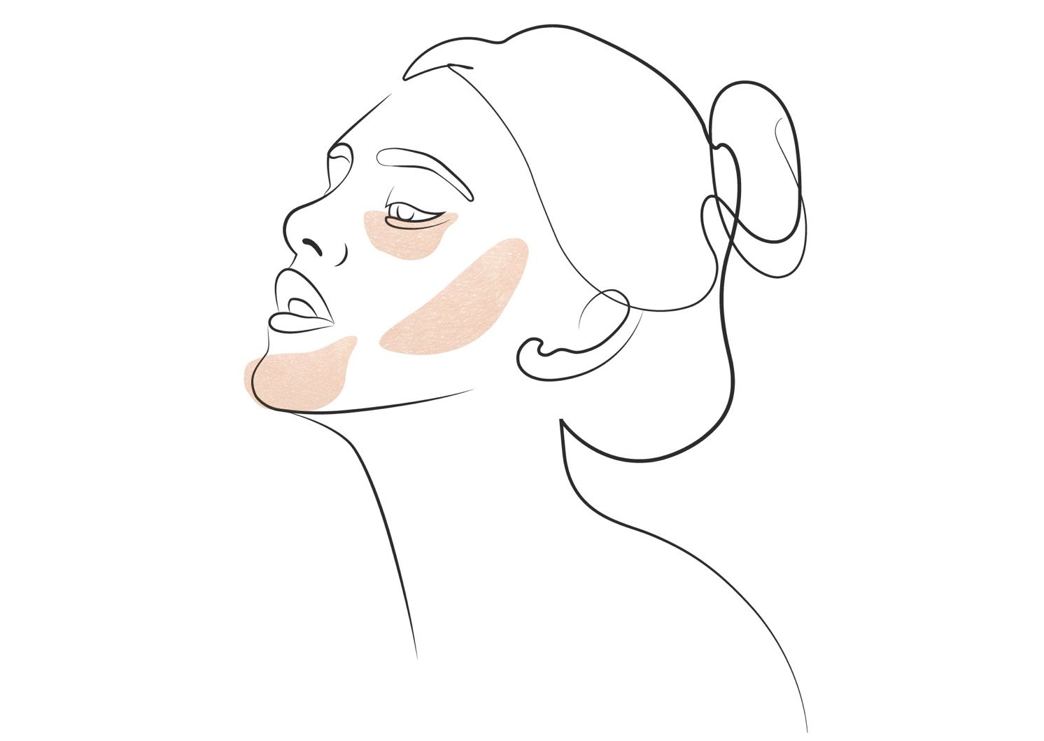 Nekirurški lifting obraza z nitmi