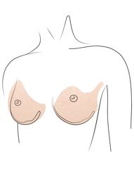 Klinika višnjar - povečanje prsi