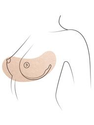 Klinika višnjar - Povečanje prsi z lastno maščobo