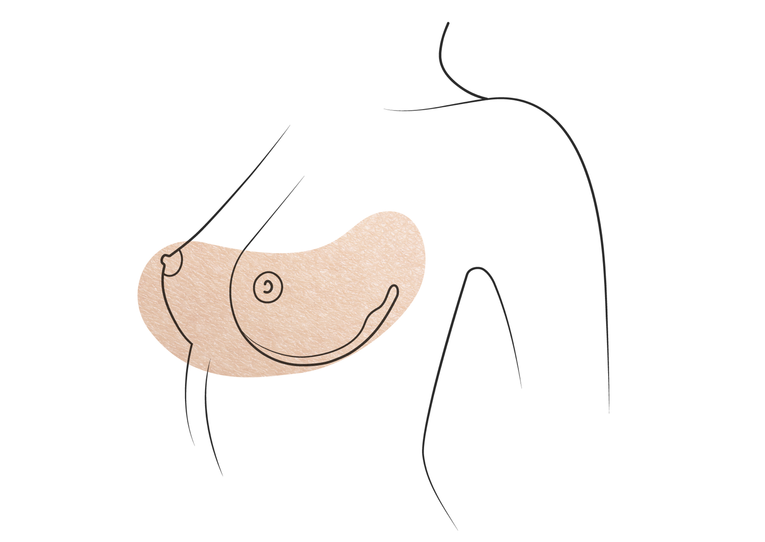 Klinika višnjar - Povečanje prsi z lastno maščobo