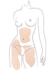 Klinika višnjar - Liposukcija z metodo VASER