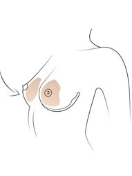 Klinika višnjar - zmanjšanje prsi