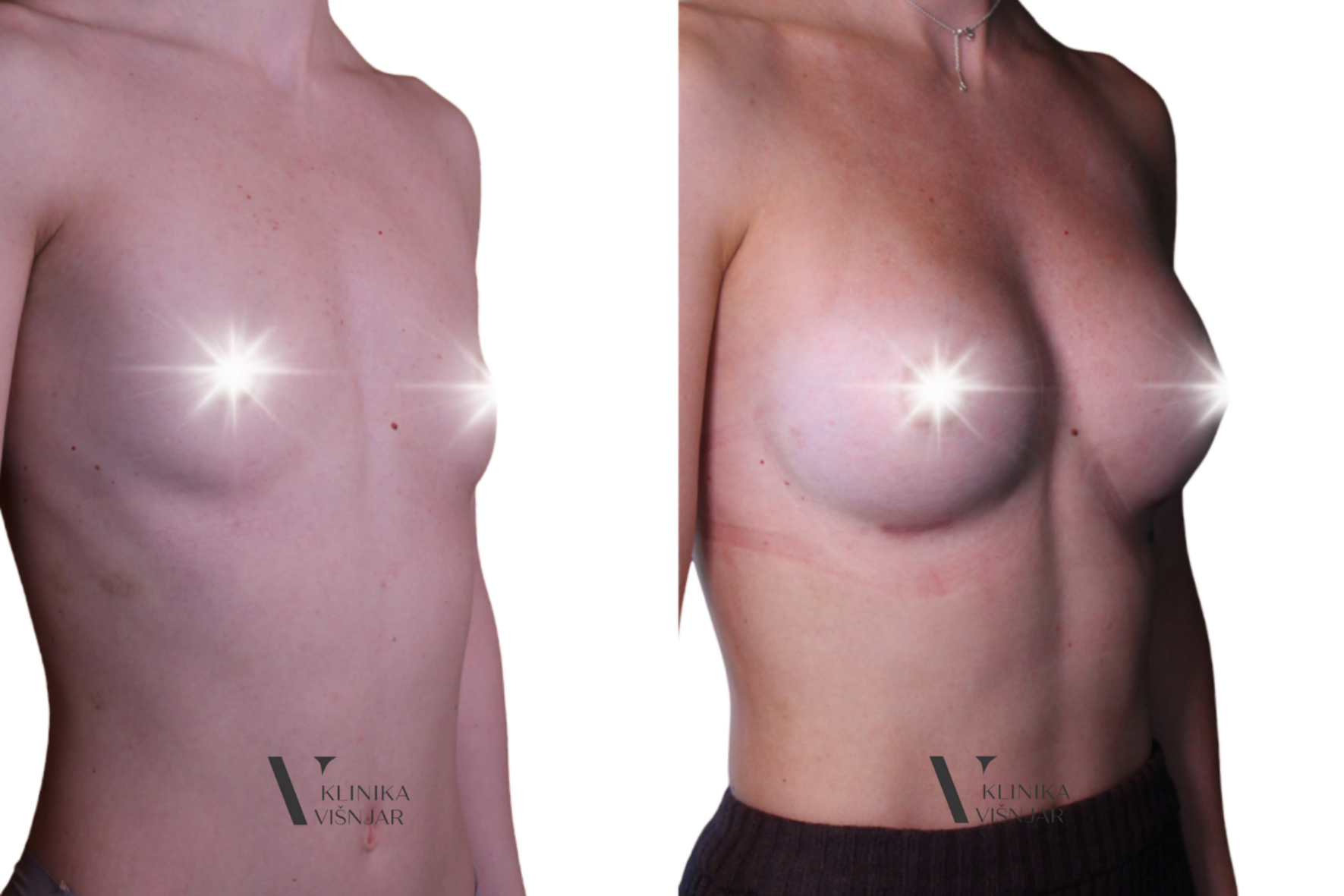Povečanje prsi z vsadki - Klinika Višnjar v Ljubljani