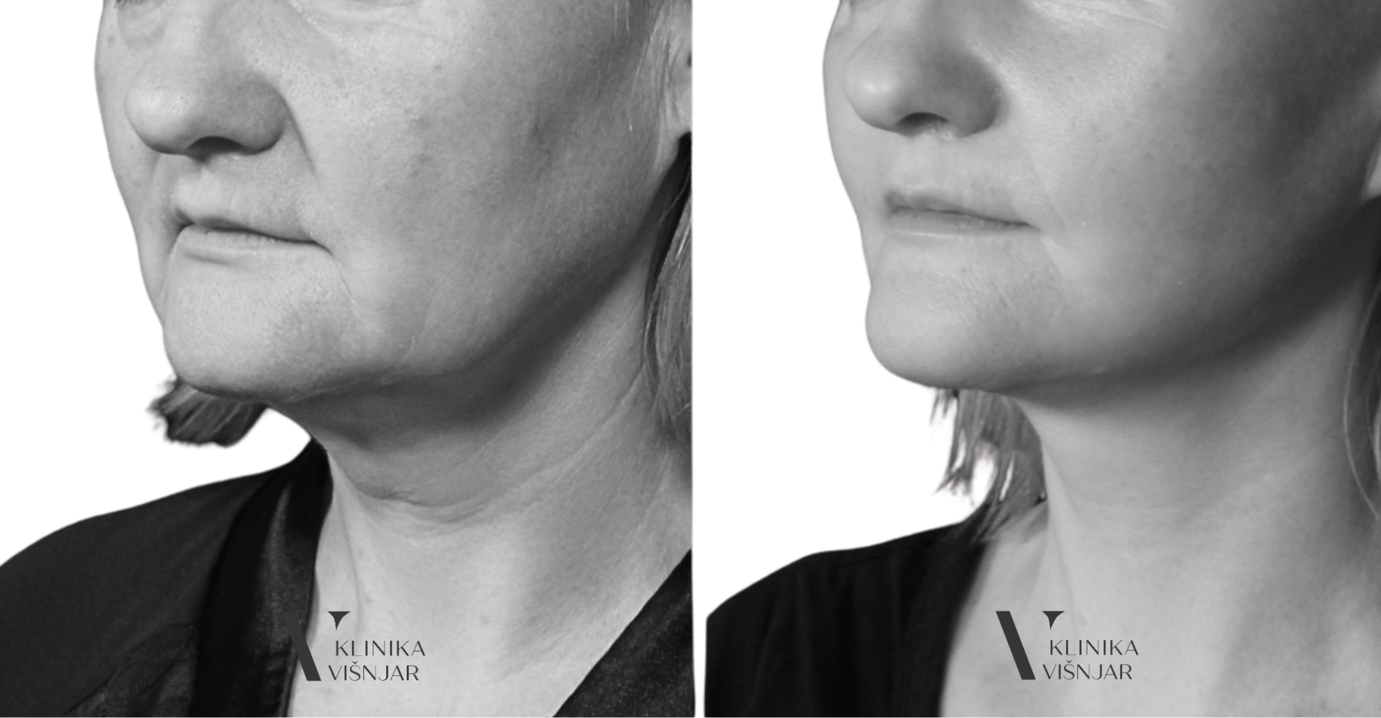 Facelift - dvig obraza PREJ/OTEM