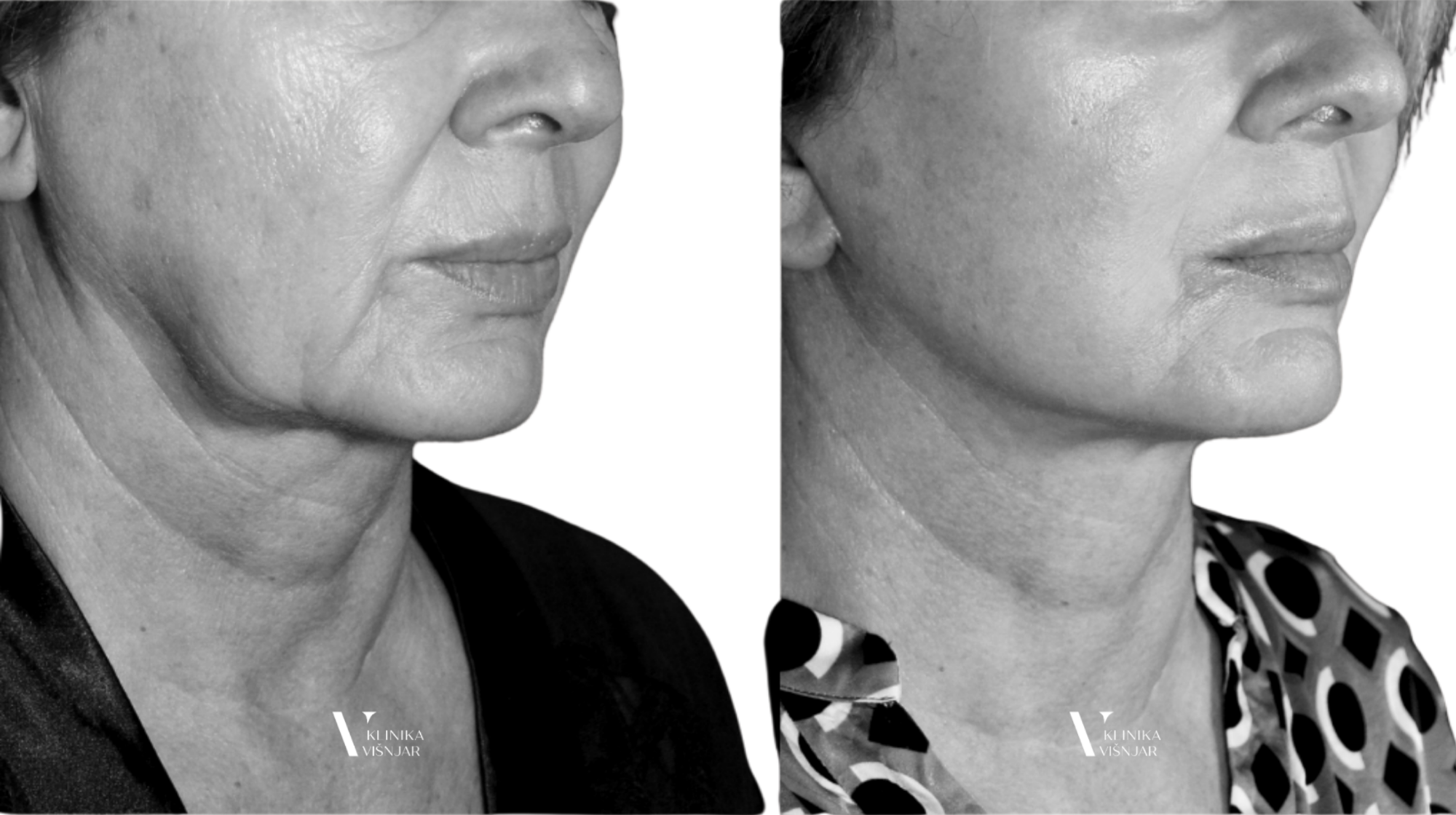 Facelift oz. dvig obraza - Prikaz pred (levo) in po operaciji (desno).