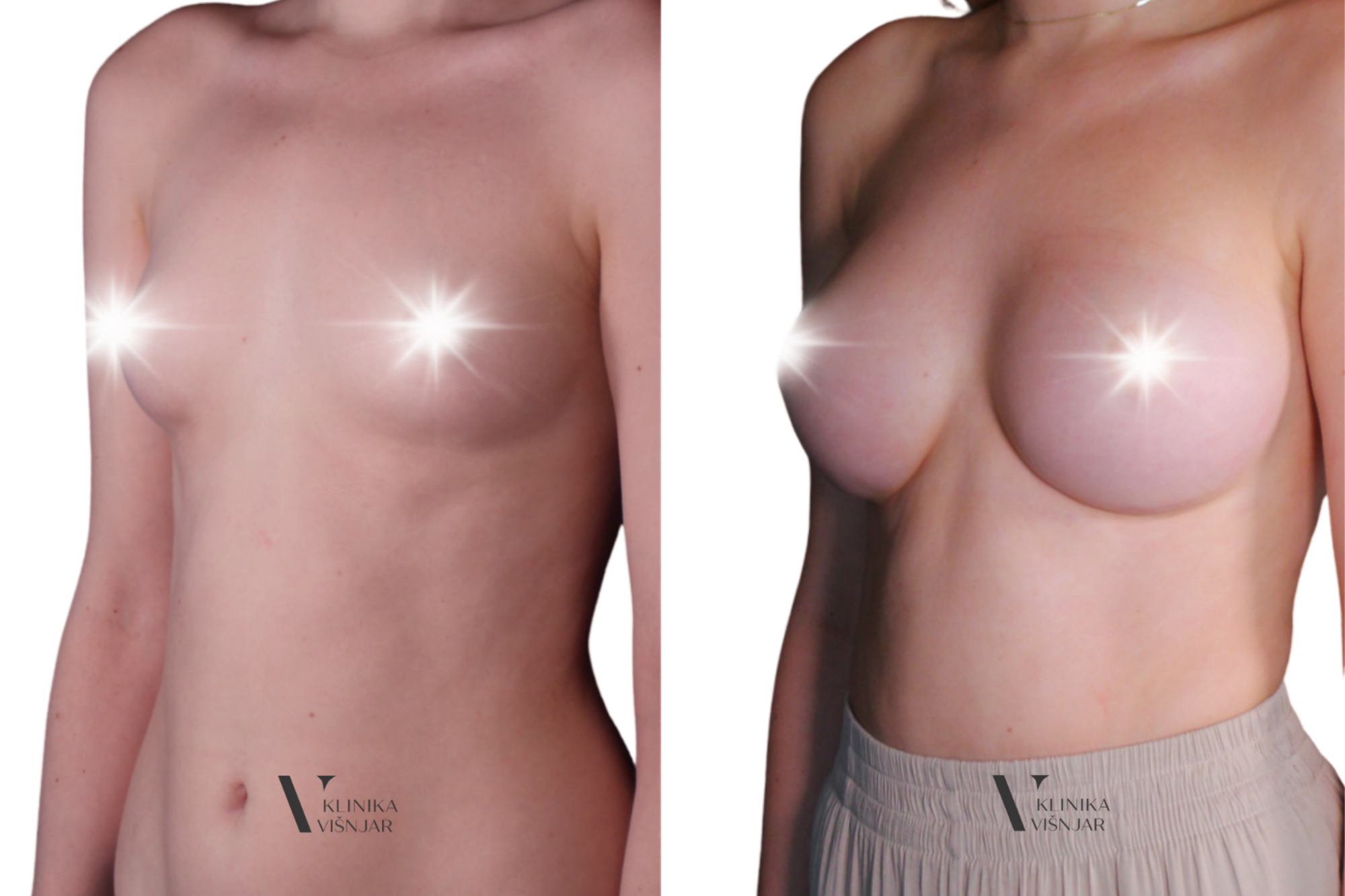 Povečanje prsi z vsadki Motiva® - Klinika VišnjarLjubljana - PREJ/POTEM